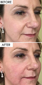 About Botox