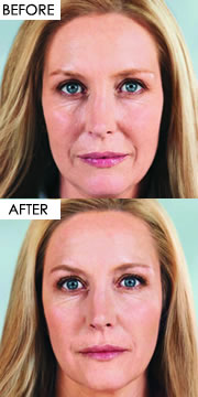 About Botox